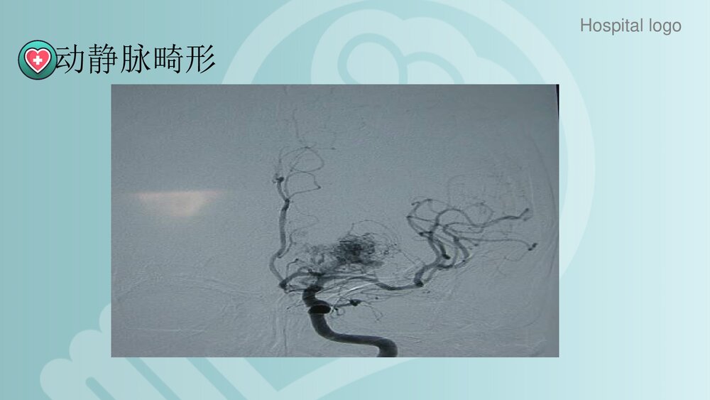 蛛网膜下腔出血PPT课件10