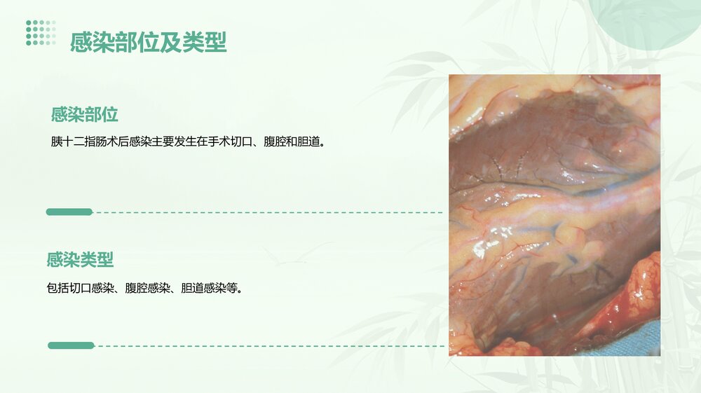 胰十二指肠术后感染的病案讨论PPT课件下载7