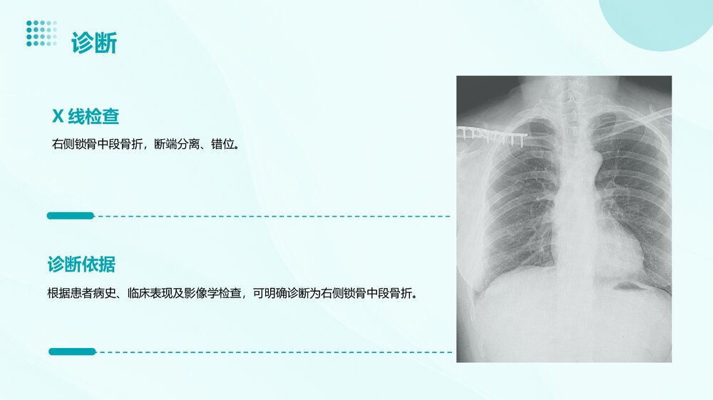 锁骨骨折护理查房PPT课件下载5