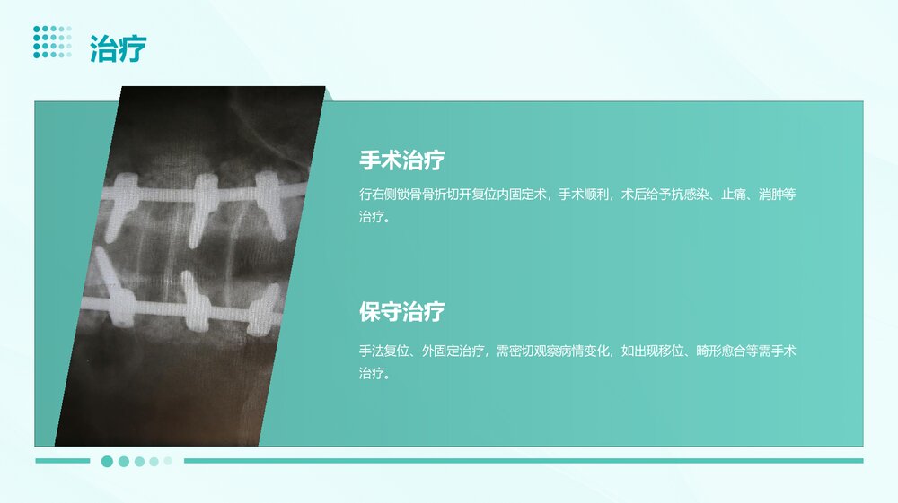 锁骨骨折护理查房PPT课件下载6