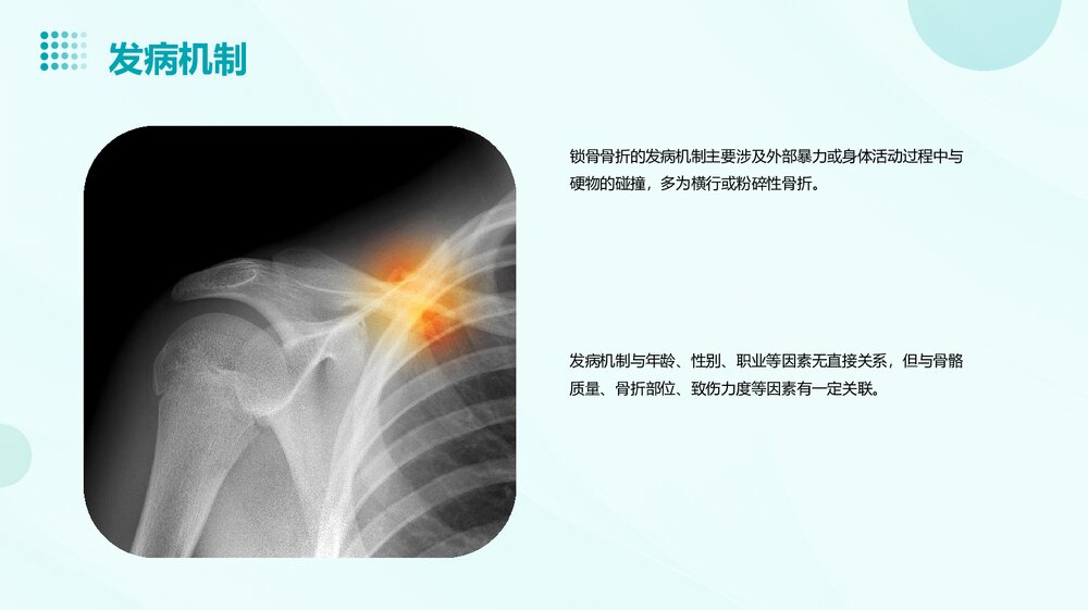 锁骨骨折护理查房PPT课件下载8