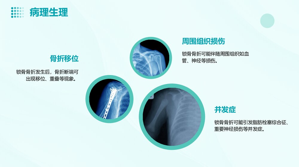 锁骨骨折护理查房PPT课件下载10