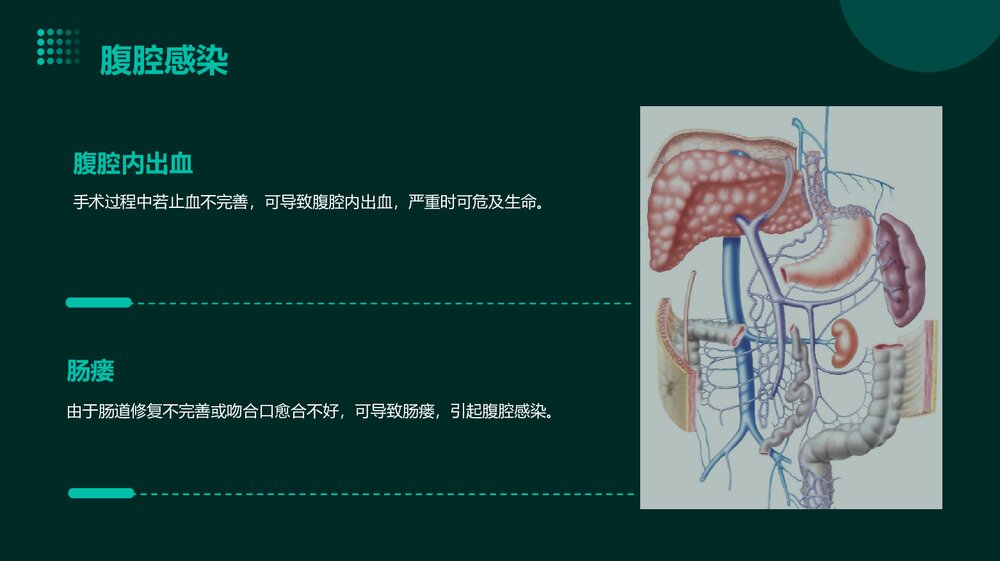 胰十二指肠术后并发症PPT课件下载8