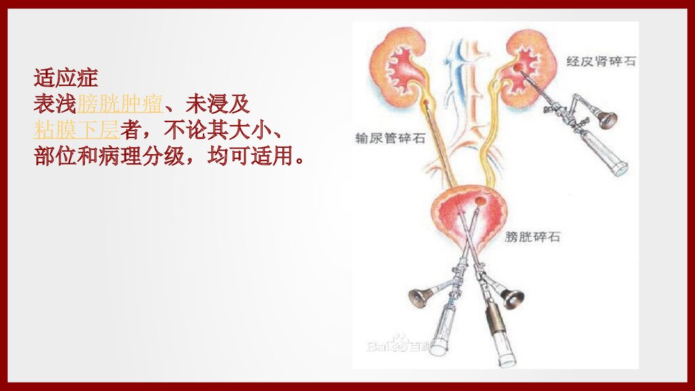 经尿道膀胱肿瘤电切术手术配合及护理查房PPT课件(共21页·可编辑修改)3