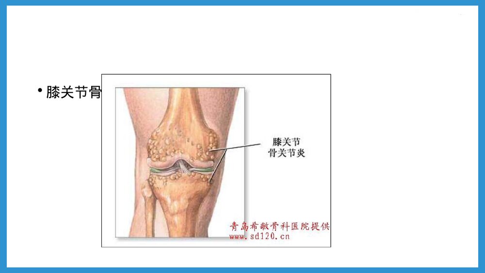 双膝骨性关节炎合并腰椎间盘突出患者的护理查房PPT课件(共48页·可编辑修改)4