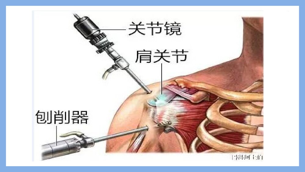 肩关节镜术后护理PPT课件下载（共21页·可编辑修改）3