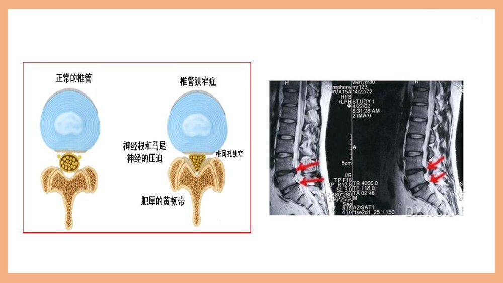 腰椎管狭窄护理PPT课件（共37页·可编辑修改）7