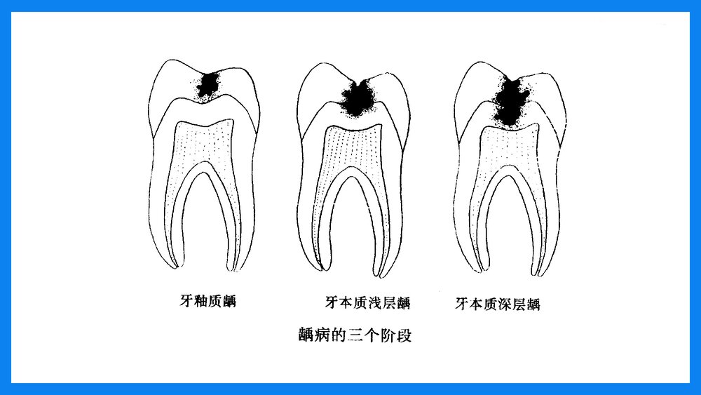 牙体及牙髓病病人的护理PPT课件(共33页·可编辑修改）7