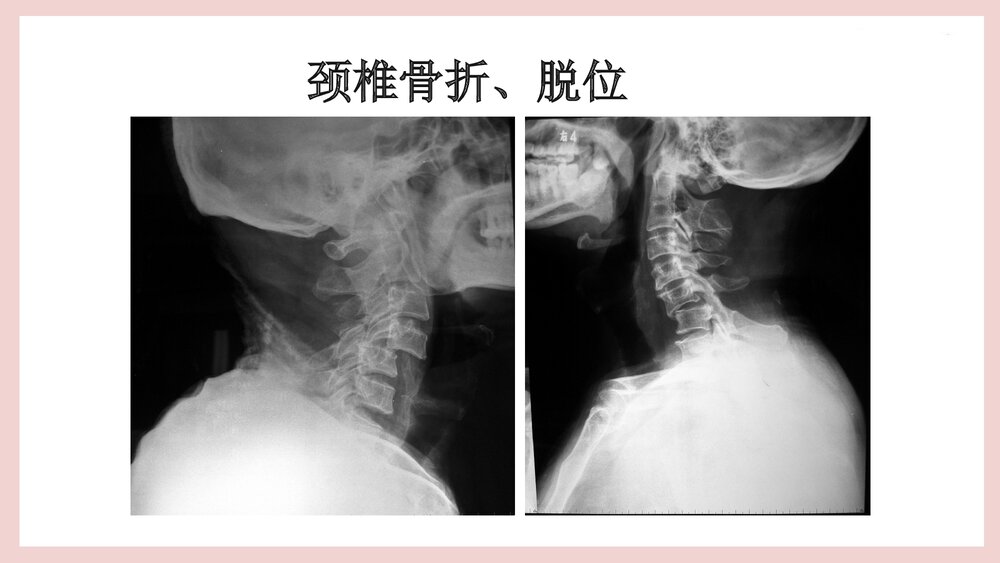 骨牵引病人的护理PPT课件（共25页·可编辑修改）9