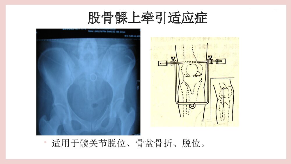 骨牵引病人的护理PPT课件（共25页·可编辑修改）10