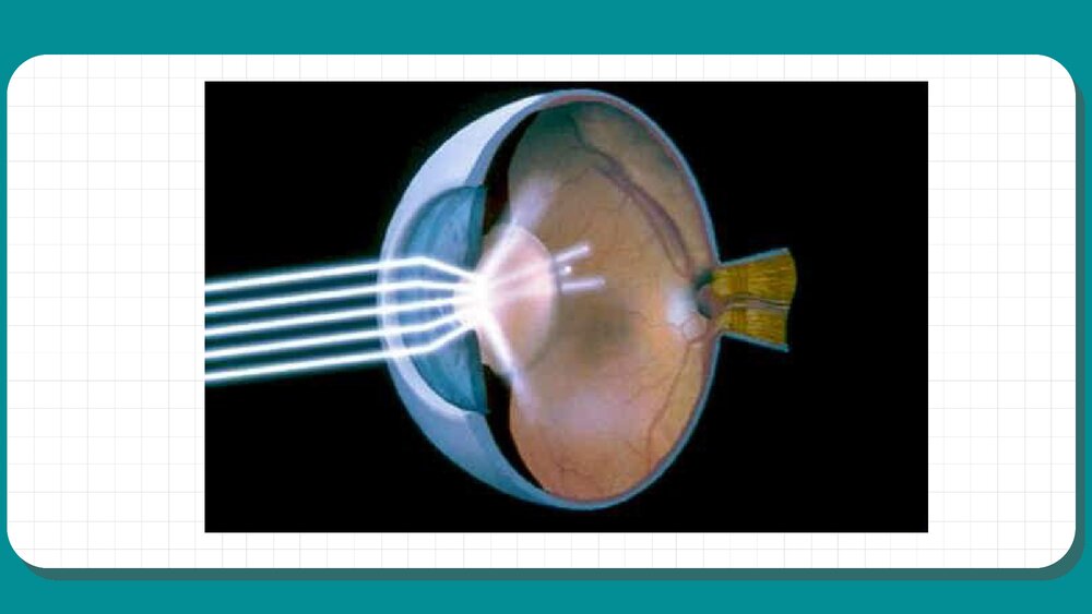 白内障护理查房教学PPT课件（共59页·可编辑修改）7