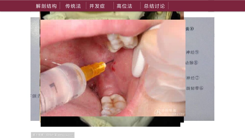 下牙槽神经阻滞麻醉PPT课件下载（共21页·可编辑修改）6