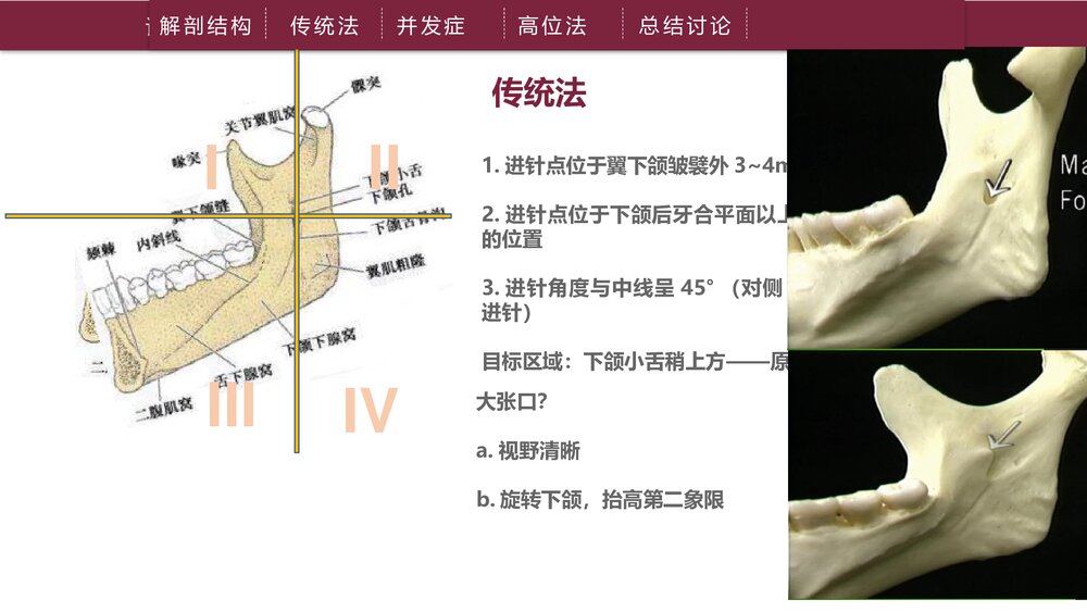 下牙槽神经阻滞麻醉PPT课件下载（共21页·可编辑修改）8