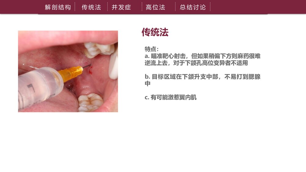 下牙槽神经阻滞麻醉PPT课件下载（共21页·可编辑修改）9