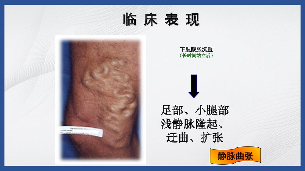 下肢静脉曲张病人的护理PPT课件8