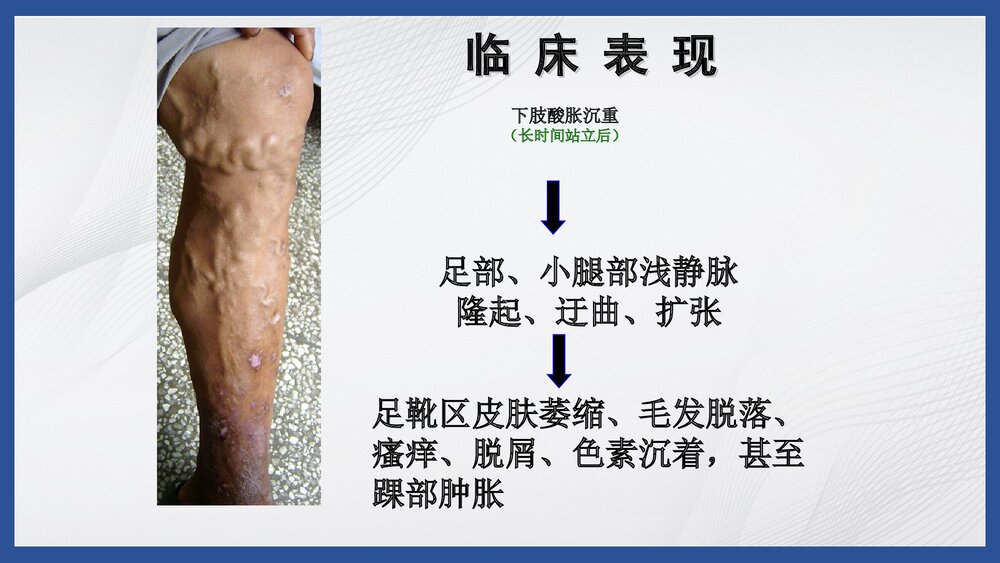 下肢静脉曲张病人的护理PPT课件9