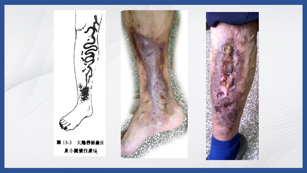 下肢静脉曲张病人的护理PPT课件10