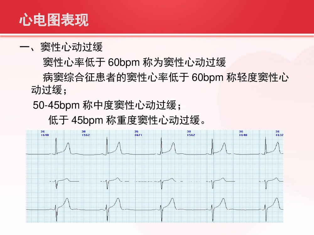 病态窦房结综合症的护理查房PPT课件（共33页可编辑修改）5