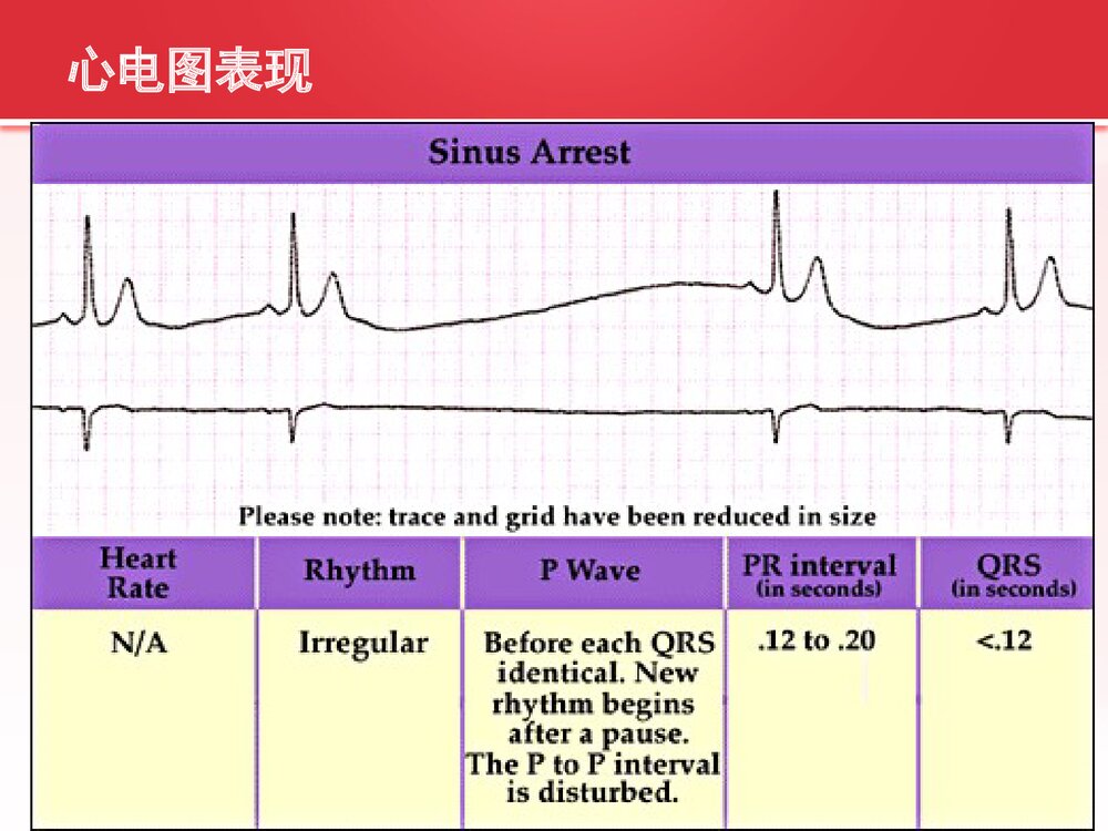 病态窦房结综合症的护理查房PPT课件（共33页可编辑修改）8