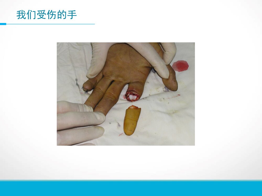 手部外伤的的护理PPT课件下载3