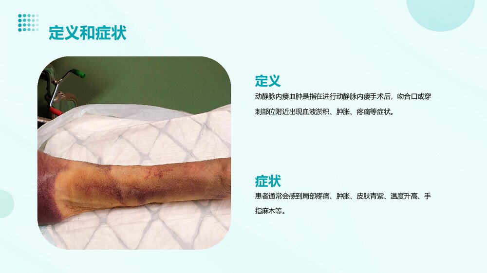 动静脉内瘘血肿处理PPT课件4