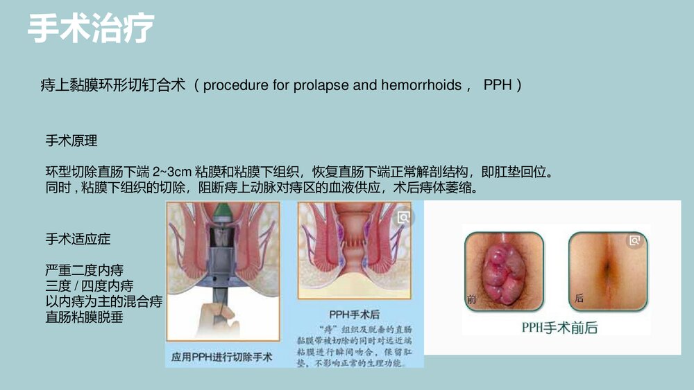 混合痔护理查房PPT课件下载9