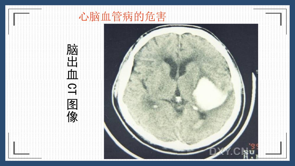 心脑血管疾病销售方案PPT课件下载9