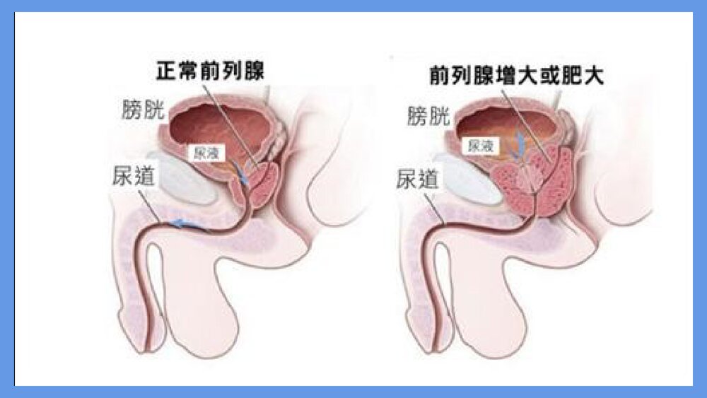前列腺电切术后的护理PPT课件下载3