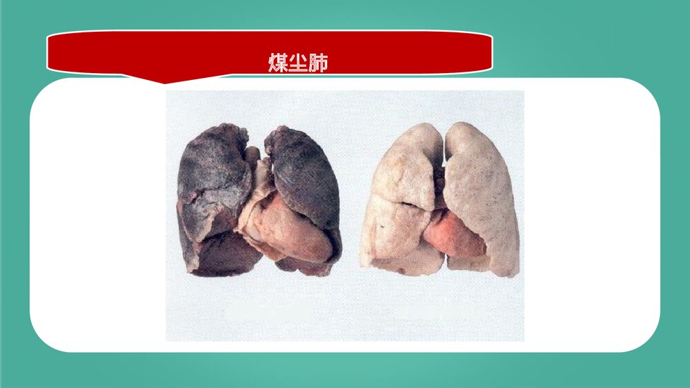 尘肺病的防治PPT课件下载3