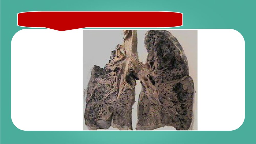 尘肺病的防治PPT课件下载4