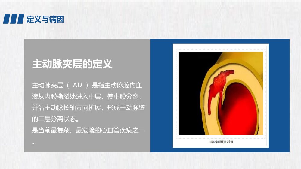主动脉夹层急救护理PPT课件下载4