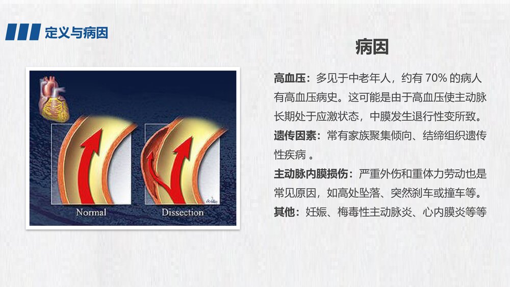 主动脉夹层急救护理PPT课件下载5