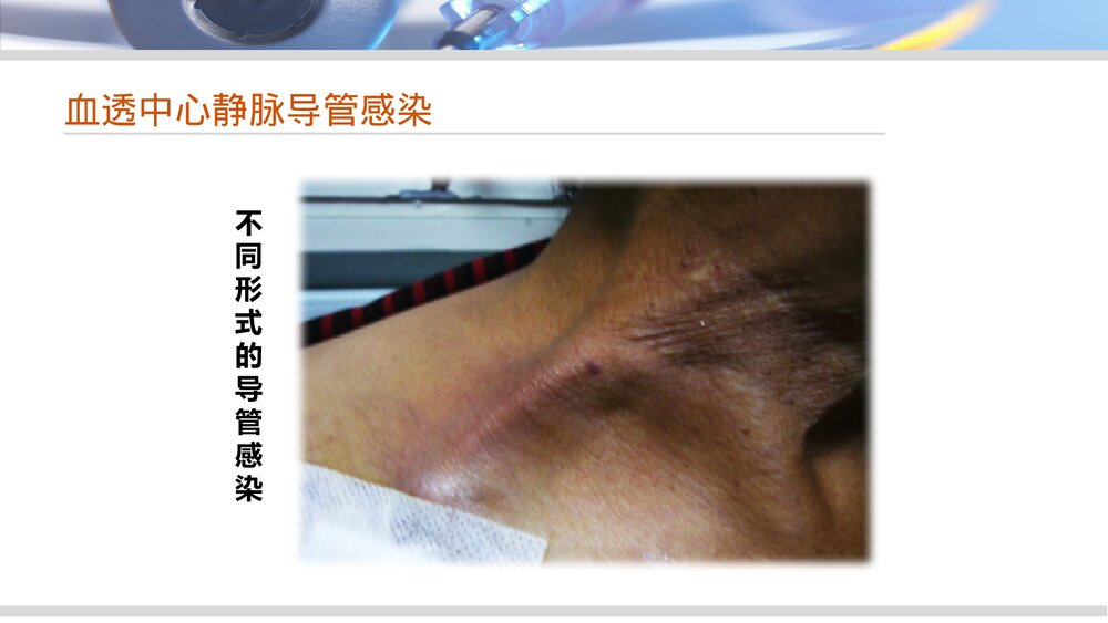 血液透析中心静脉导管感染的护理管理PPT课件下载8