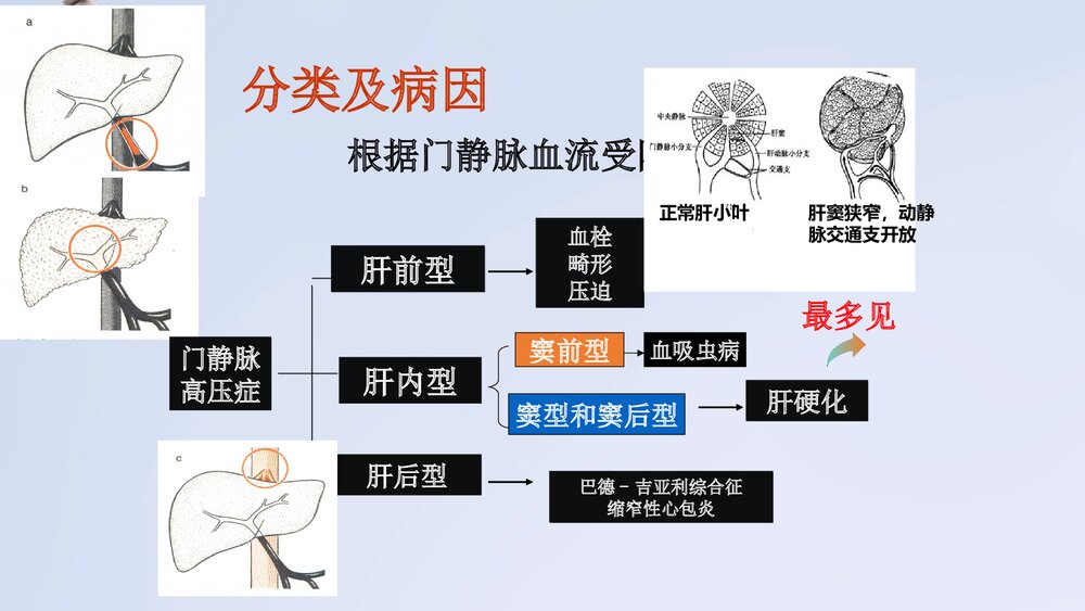 门静脉高压症病人护理PPT课件下载8