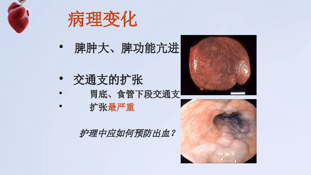 门静脉高压症病人护理PPT课件下载9