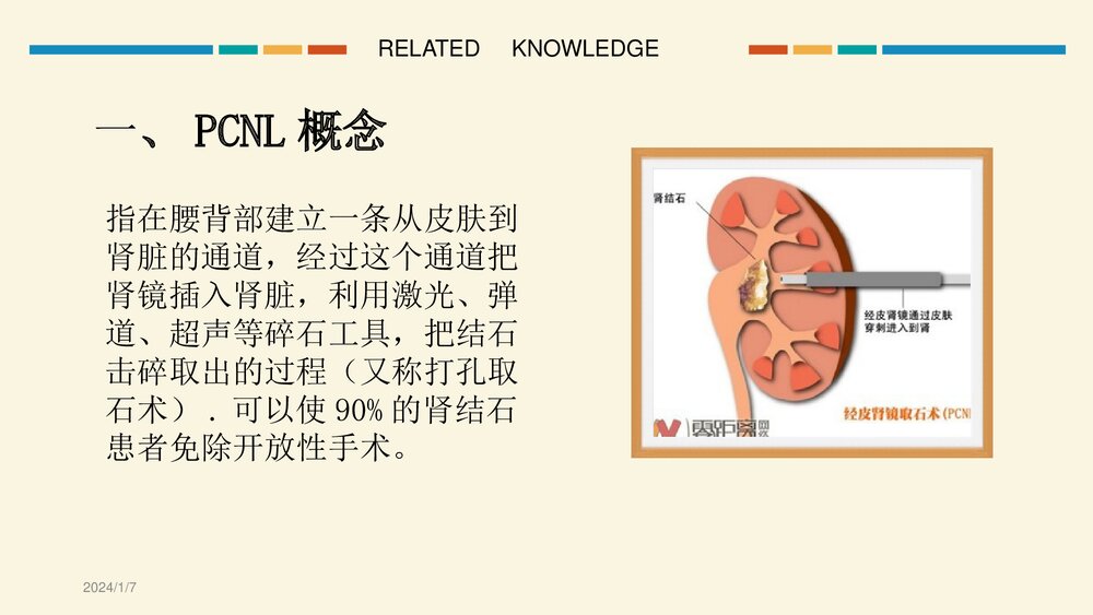 经皮肾镜超声碎石取石手术护理查房PPT课件4