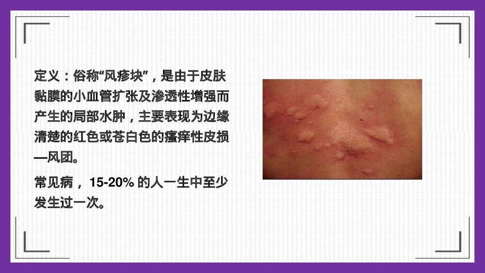 荨麻疹护理PPT课件下载2