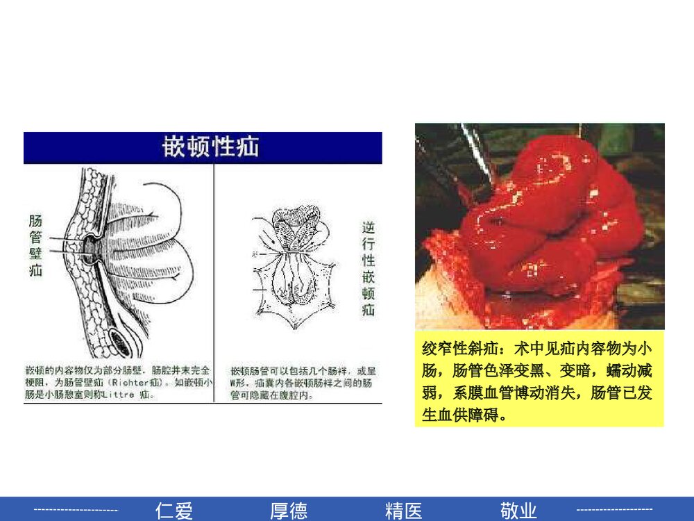 腹外疝病人的护理PPT课件7