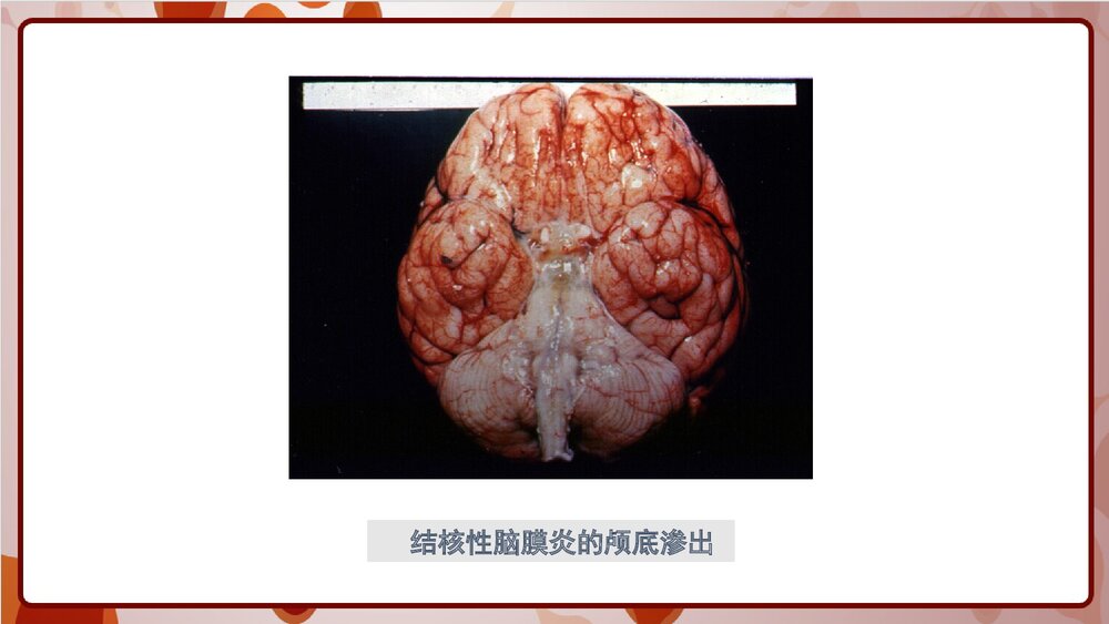 结核性脑膜炎的护理PPT课件6
