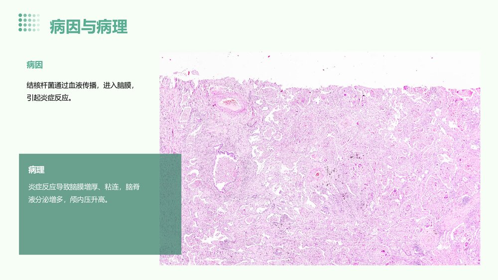 结核性脑膜炎的护理查房PPT课件下载5