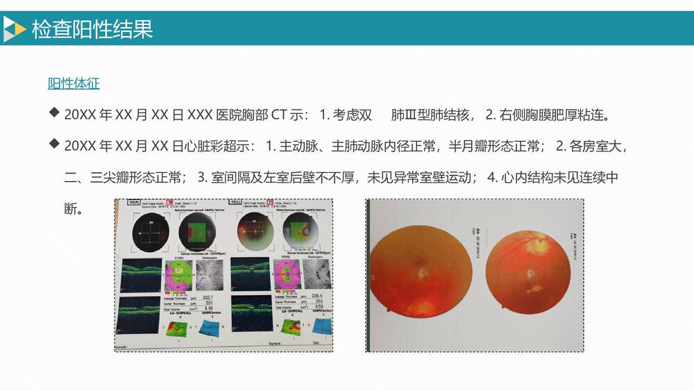 疑难病例讨论肺结核合并糖尿病护理PPT7