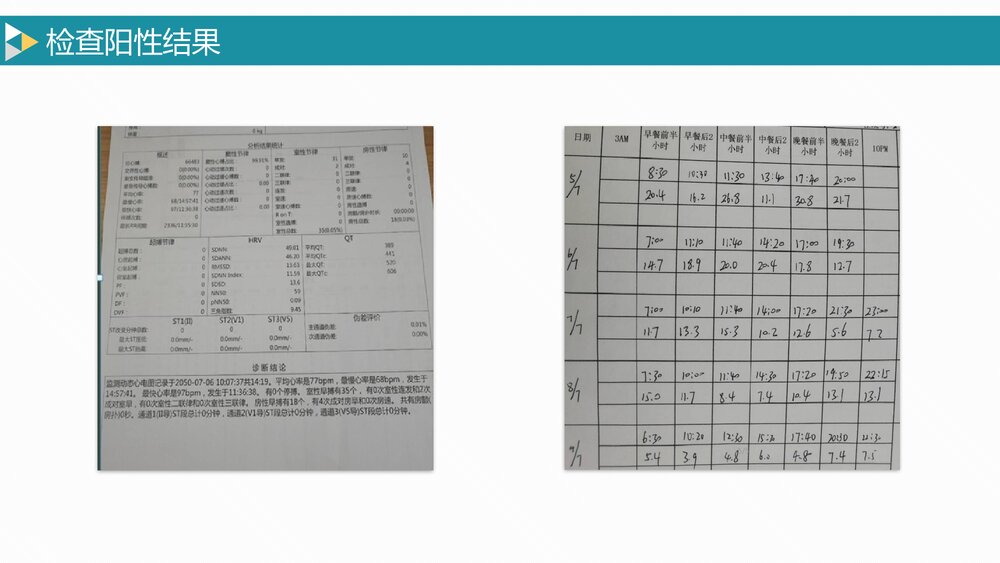 疑难病例讨论肺结核合并糖尿病护理PPT8