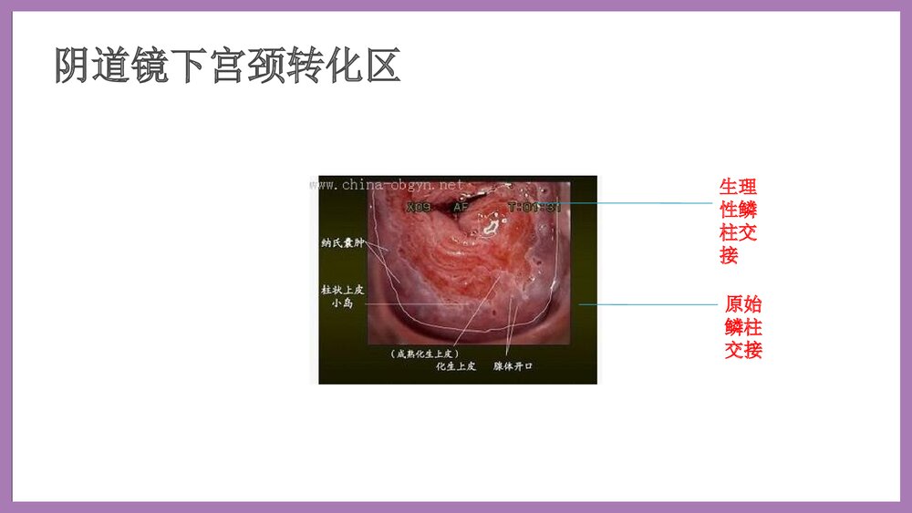 宫颈癌培训泡泡堂课件下载7
