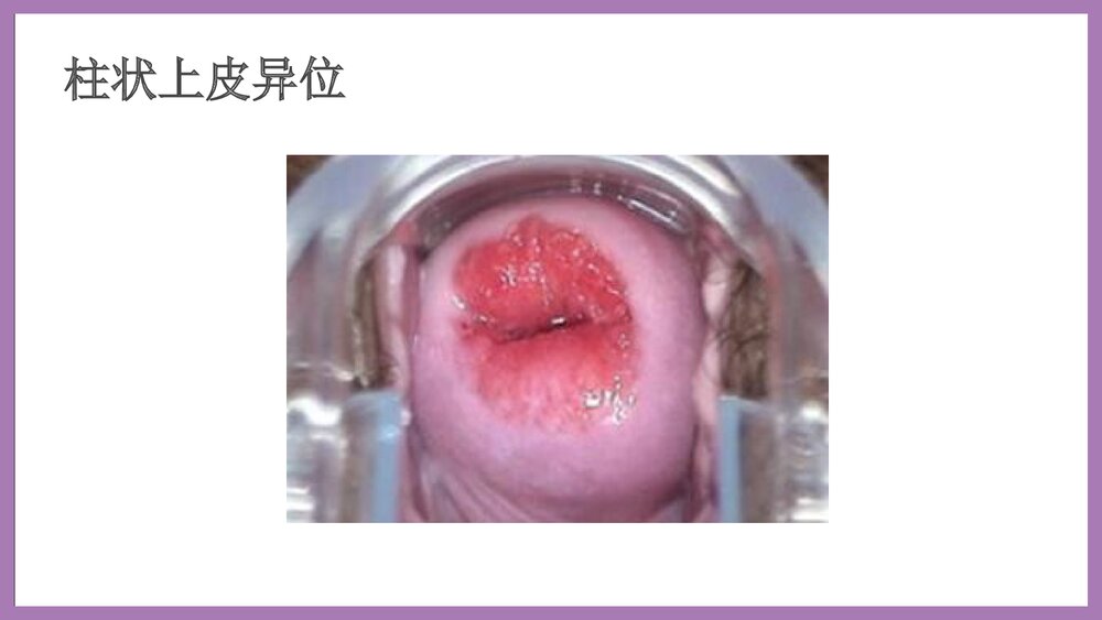 宫颈癌培训泡泡堂课件下载8