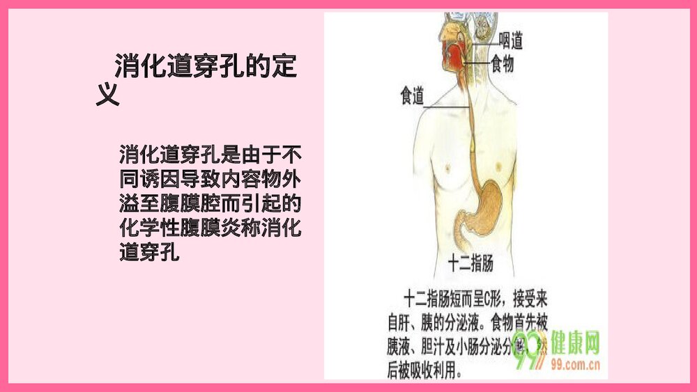 消化道穿孔术后护理查房PPT课件3