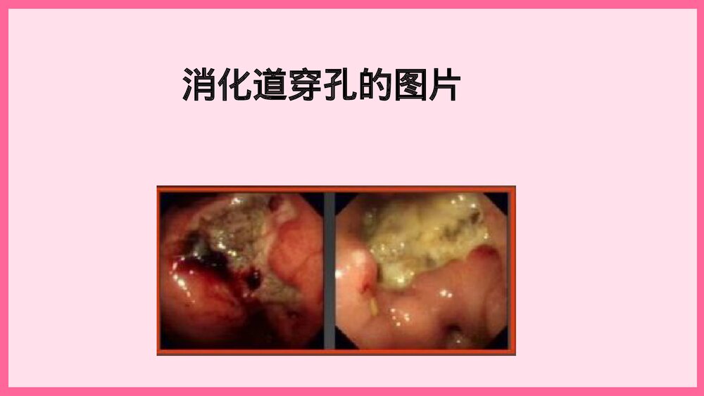 消化道穿孔术后护理查房PPT课件6