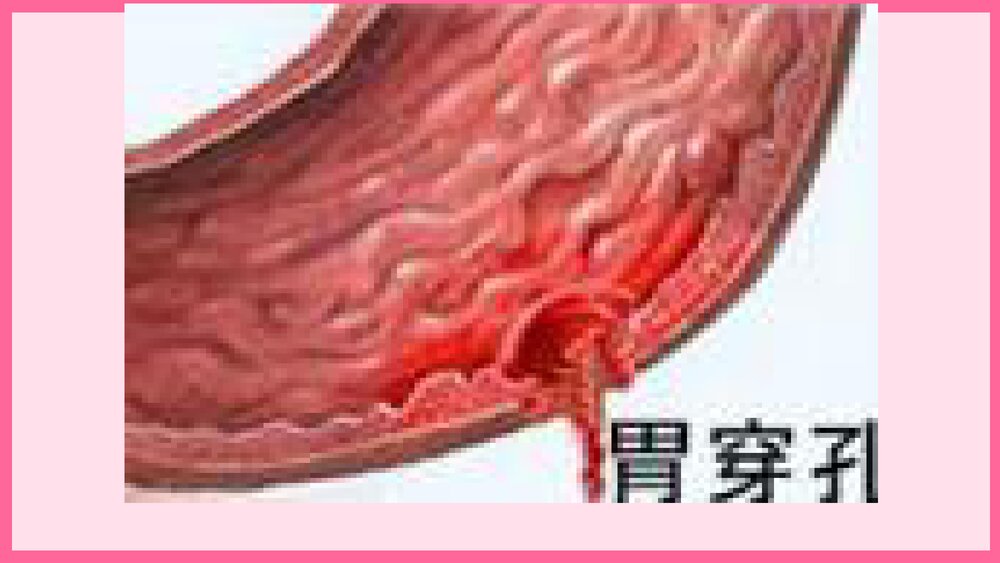 消化道穿孔术后护理查房PPT课件9
