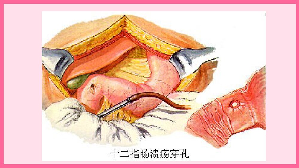 消化道穿孔术后护理查房PPT课件10