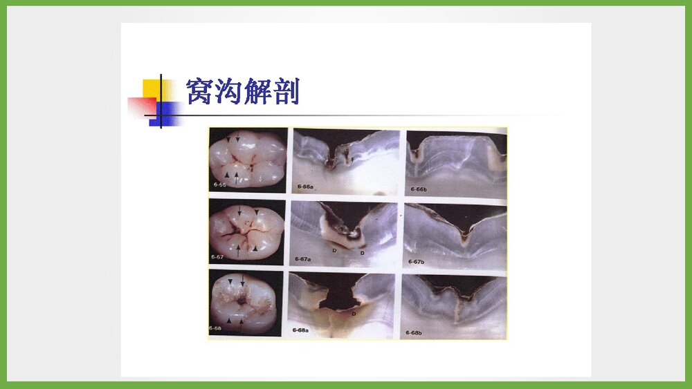 儿童窝沟封闭项目简介PPT课件3