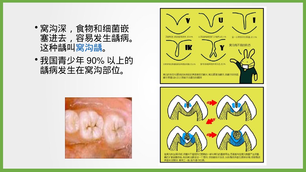 儿童窝沟封闭项目简介PPT课件5